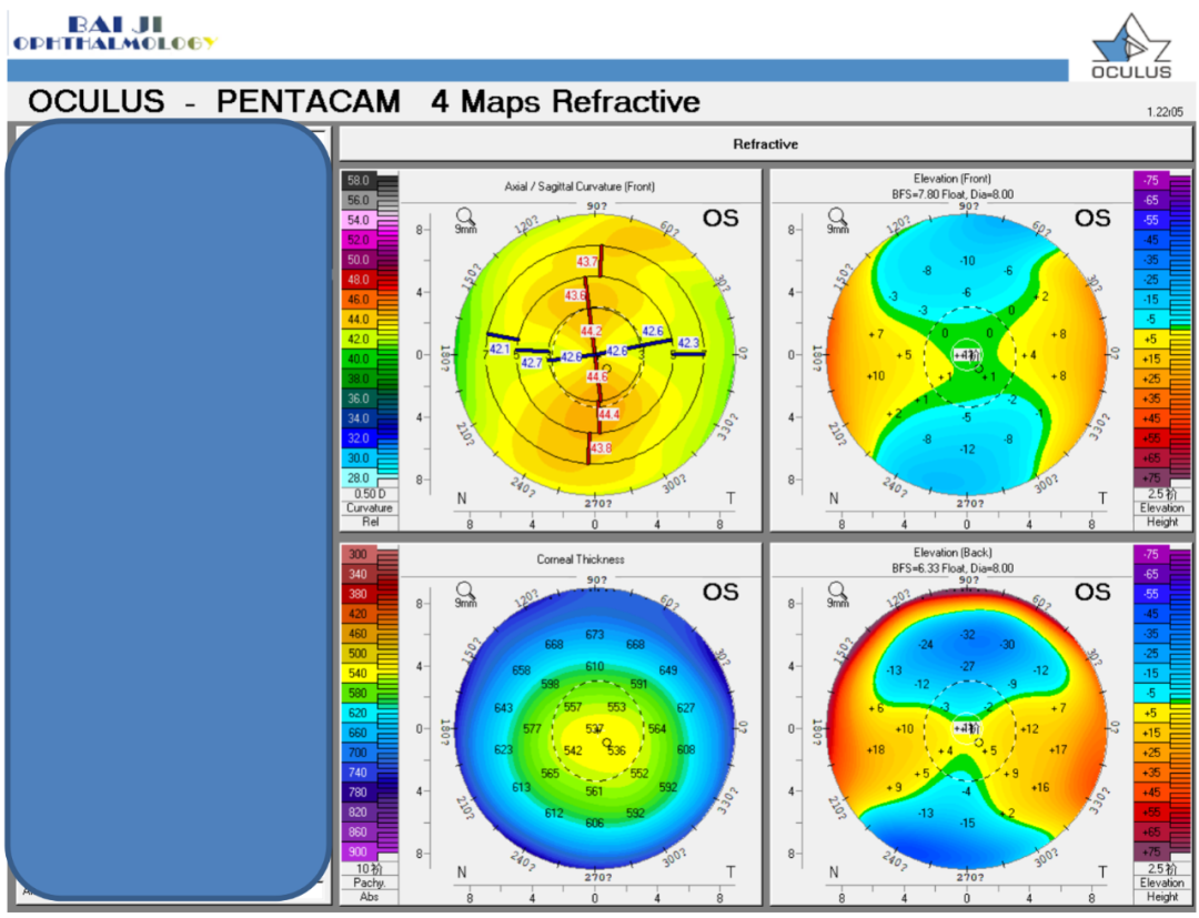 PRESBYOND融合视觉治疗老视病例分享(图7)