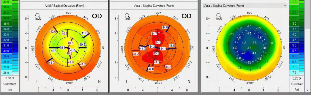 PRESBYOND融合视觉治疗老视病例分享(图14)