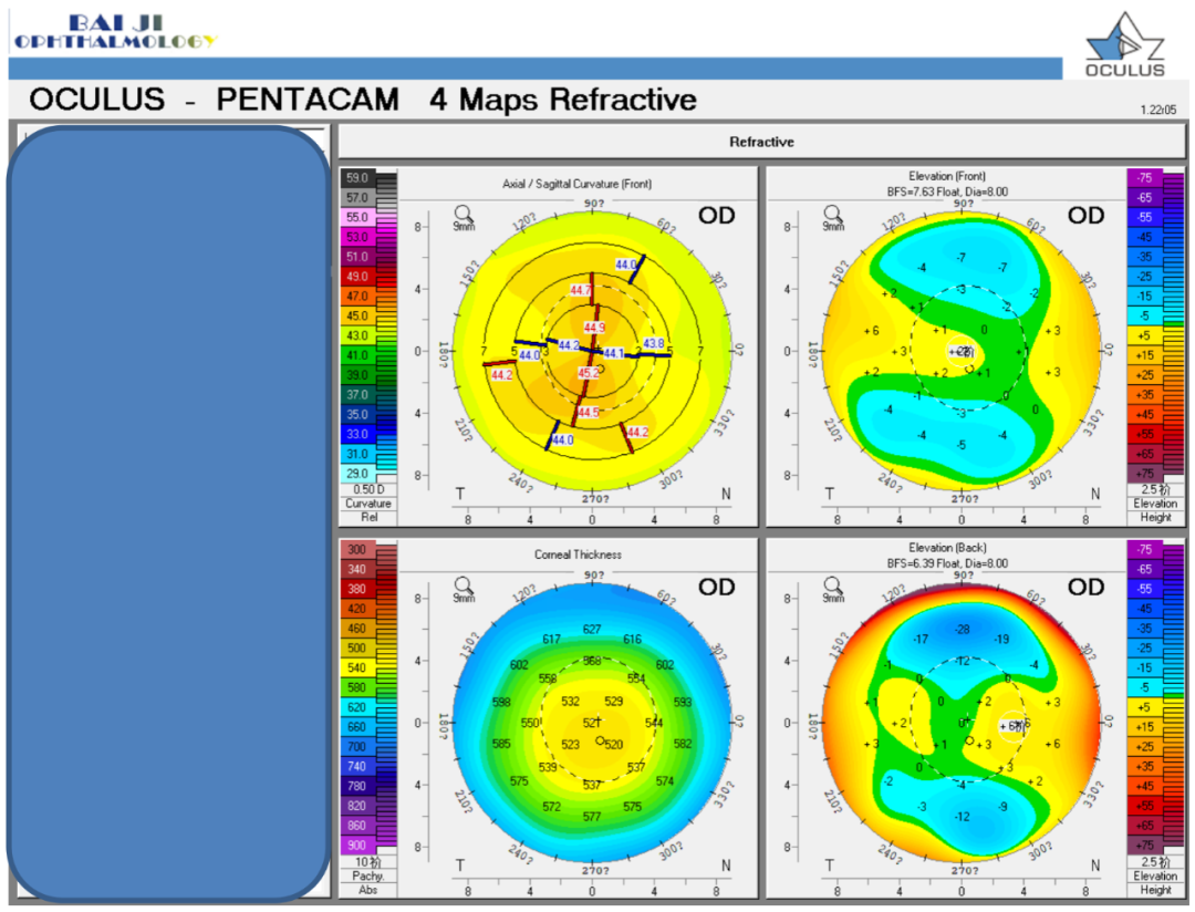 PRESBYOND融合视觉治疗老视病例分享(图6)
