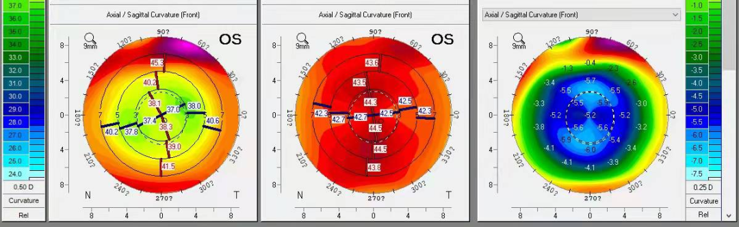 PRESBYOND融合视觉治疗老视病例分享(图15)